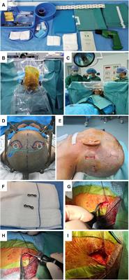 Deep Brain Stimulation Complications in Patients With Parkinson’s Disease and Surgical Modifications: A Single-Center Retrospective Analysis